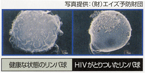 HIVウィルス